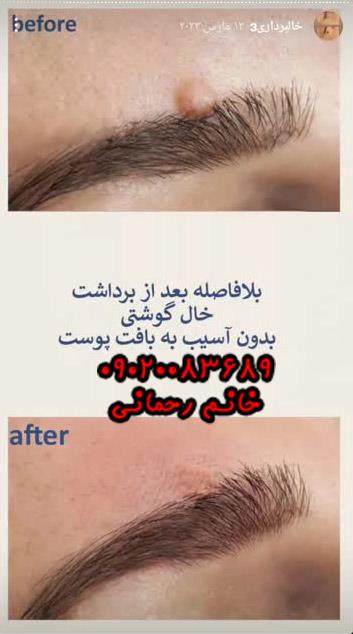 اسم محلول برداشتن خال گوشتی | معرفی بهترین داروی گیاهی برای حذف خال‌های پوست