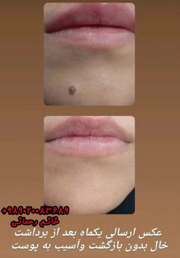 محلول برای از بین بردن خال گوشتی: بررسی بهترین گزینه‌های خانگی و دارویی