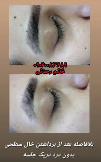 برداشتن خال عطاری | بهترین روش طبیعی و موثر حذف خال‌های پوستی