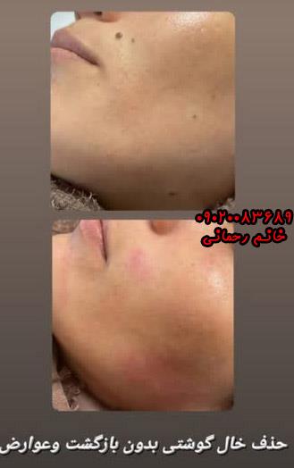 از بین بردن خال‌های سطحی صورت طب سنتی | درمان سریع و طبیعی خال‌های صورت با داروهای گیاهی