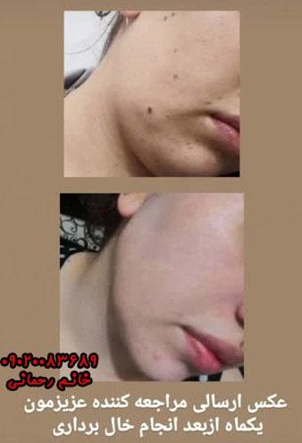 محلول برداشتن خال گوشتی | درمان خانگی، بدون جراحی و کاملاً گیاهی