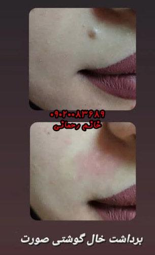 بهترین محلول برای رفع کک و مک | درمان گیاهی سریع و مؤثر کک‌ و مک صورت