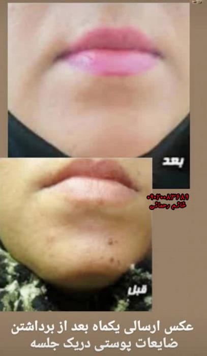 بهترین محلول بعد از برداشتن خال | راهنمای کامل ترمیم و مراقبت پوست