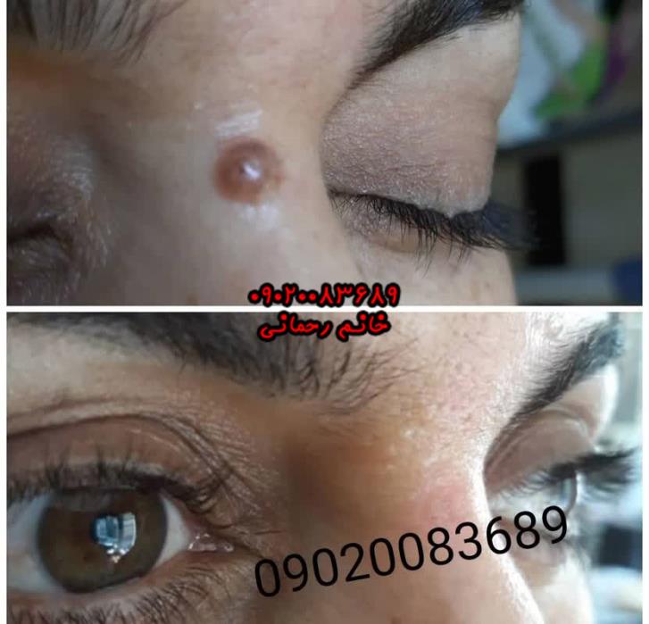 برداشتن خال گوشتی در خانه | راهنمای کامل و طبیعی حذف خال با محلول گیاهی