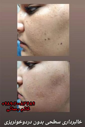 بهترین فصل برای برداشتن خال صورت | رازهای زمان‌بندی برای نتایج عالی