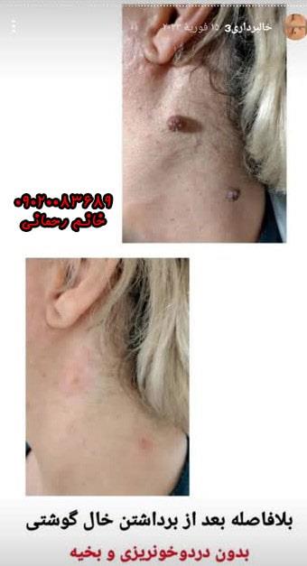 محلول برای کک و مک |  روش های خانگی و تخصصی برای حذف سریع لک‌های صورت