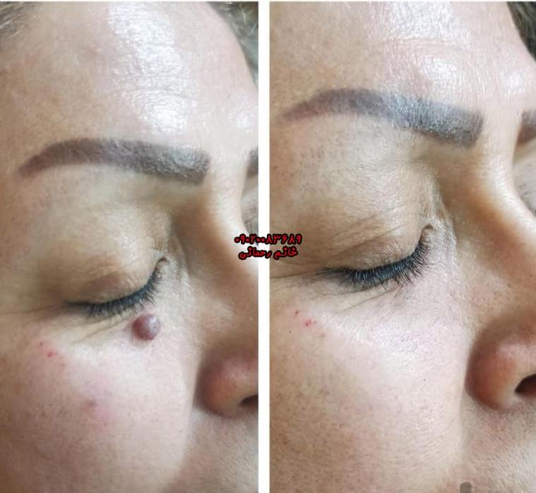 هزینه برداشتن خال | قیمت واقعی روش‌ها + جایگزین خانگی کم‌هزینه