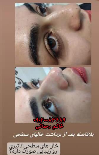 فیلم استفاده از قطره میخچه | آموزش گام به گام درمان سریع و بدون درد میخچه