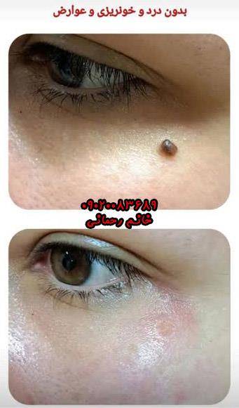 محلول برداشتن کک‌ومک: سریع‌ترین و طبیعی‌ترین راه درمان خانگی