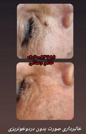 محلول از بین بردن خال صورت | راهنمای ورود به زیبایی طبیعی پوست