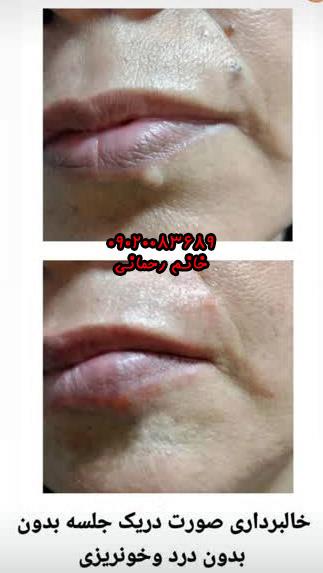 اسم قطره برداشتن خال | بهترین قطره گیاهی قوی برای خال صورت و بدن