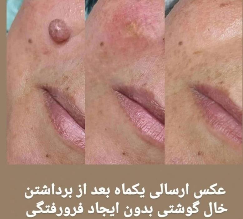 برداشتن خال و زگیل در ۱۰ روز ✅ با محلول گیاهی اسید میوه | تضمینی، بدون درد و جراحی