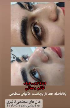 برداشتن خال با مواد گیاهی و محلول | راهکار طبیعی و موثر برای حذف خال‌های پوستی