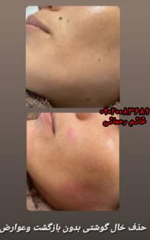 از بین بردن خال‌های سطحی صورت طب سنتی | درمان سریع و طبیعی خال‌های صورت با داروهای گیاهی