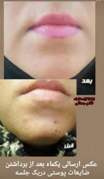 بهترین محلول بعد از برداشتن خال | راهنمای کامل ترمیم و مراقبت پوست