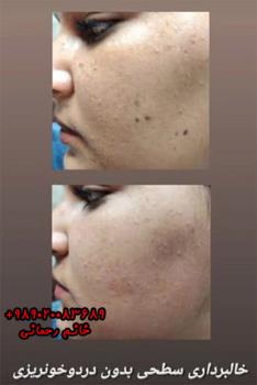 بهترین فصل برای برداشتن خال صورت | رازهای زمان‌بندی برای نتایج عالی