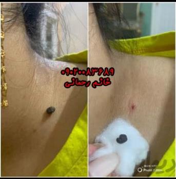 مراقبت بعد از برداشتن خال با محلول | راهنمای کوتاه و کاربردی