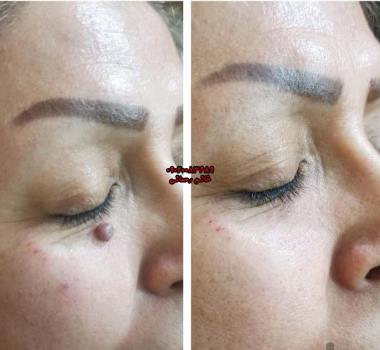 هزینه برداشتن خال | قیمت واقعی روش‌ها + جایگزین خانگی کم‌هزینه