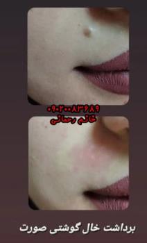محلول از بین بردن خال صورت | راهنمای ورود به زیبایی طبیعی پوست