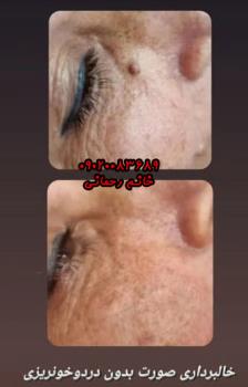 محلول از بین بردن خال صورت | راهنمای ورود به زیبایی طبیعی پوست