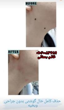عوارض برداشتن خال صورت | راهنمای کامل پیشگیری و درمان بی‌زخم