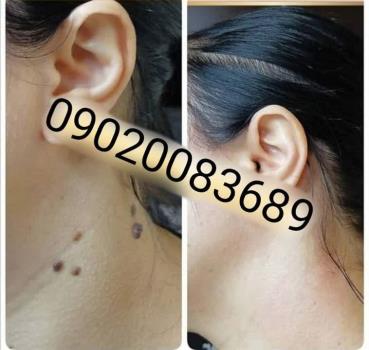 محلول برداشتن خال | راهنمای موثر و گیاهی برای حذف خال در خانه