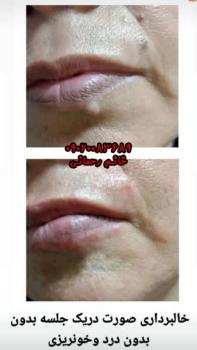 اسم قطره برداشتن خال | بهترین قطره گیاهی قوی برای خال صورت و بدن