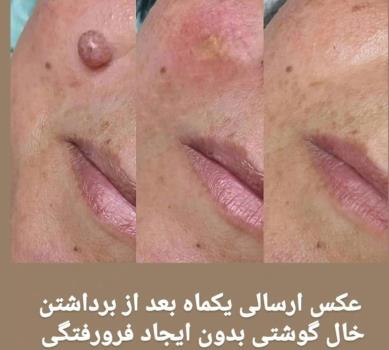 برداشتن خال و زگیل در ۱۰ روز ✅ با محلول گیاهی اسید میوه | تضمینی، بدون درد و جراحی