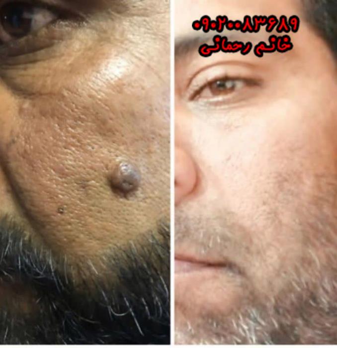 محلول خال برداری گیاهی و درمان خال ، زگیل تناسلی  ، میخچه