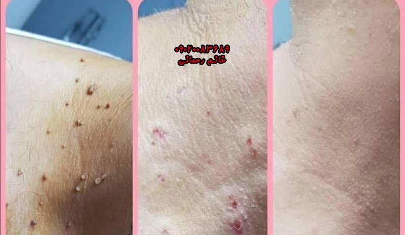 محلول خال برداری گیاهی و درمان خال ، زگیل تناسلی  ، میخچه