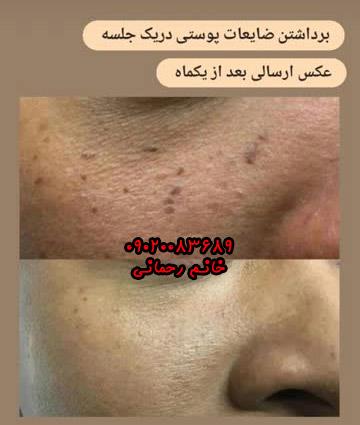 محلول خال برداری گیاهی و درمان خال ، زگیل تناسلی  ، میخچه
