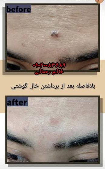 محلولهای طبیعی و گیاهی برای حذف خالهای گوشتی