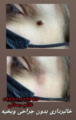 محلول-برای-از-بین-بردن-خال-گوشتی:-بررسی-بهترین-گزینه‌های-خانگی-و-دارویی