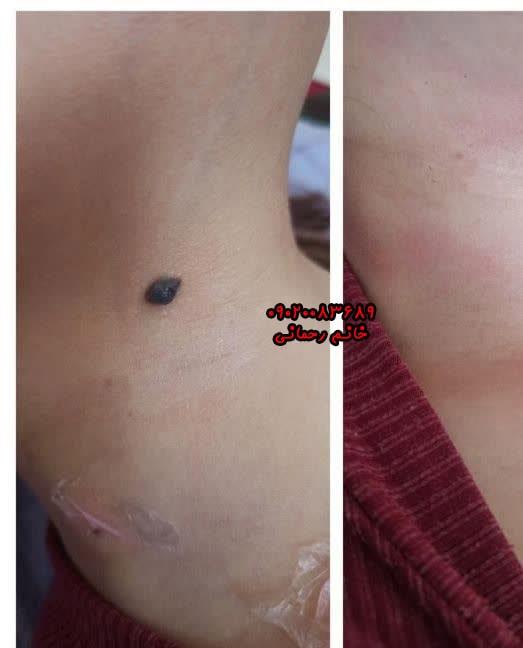 محلول برداشتن خال گوشتی